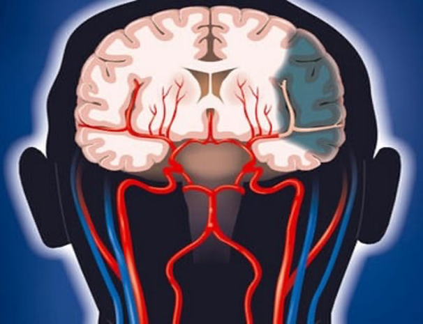 Ictus y enfermedades cerebrovasculares